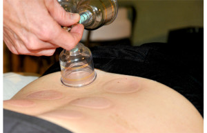 Cupping1