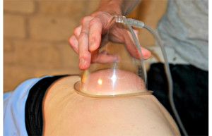 Cupping3
